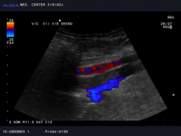 Ultrazvok žil trebuha - tromboza iliakalnih ven